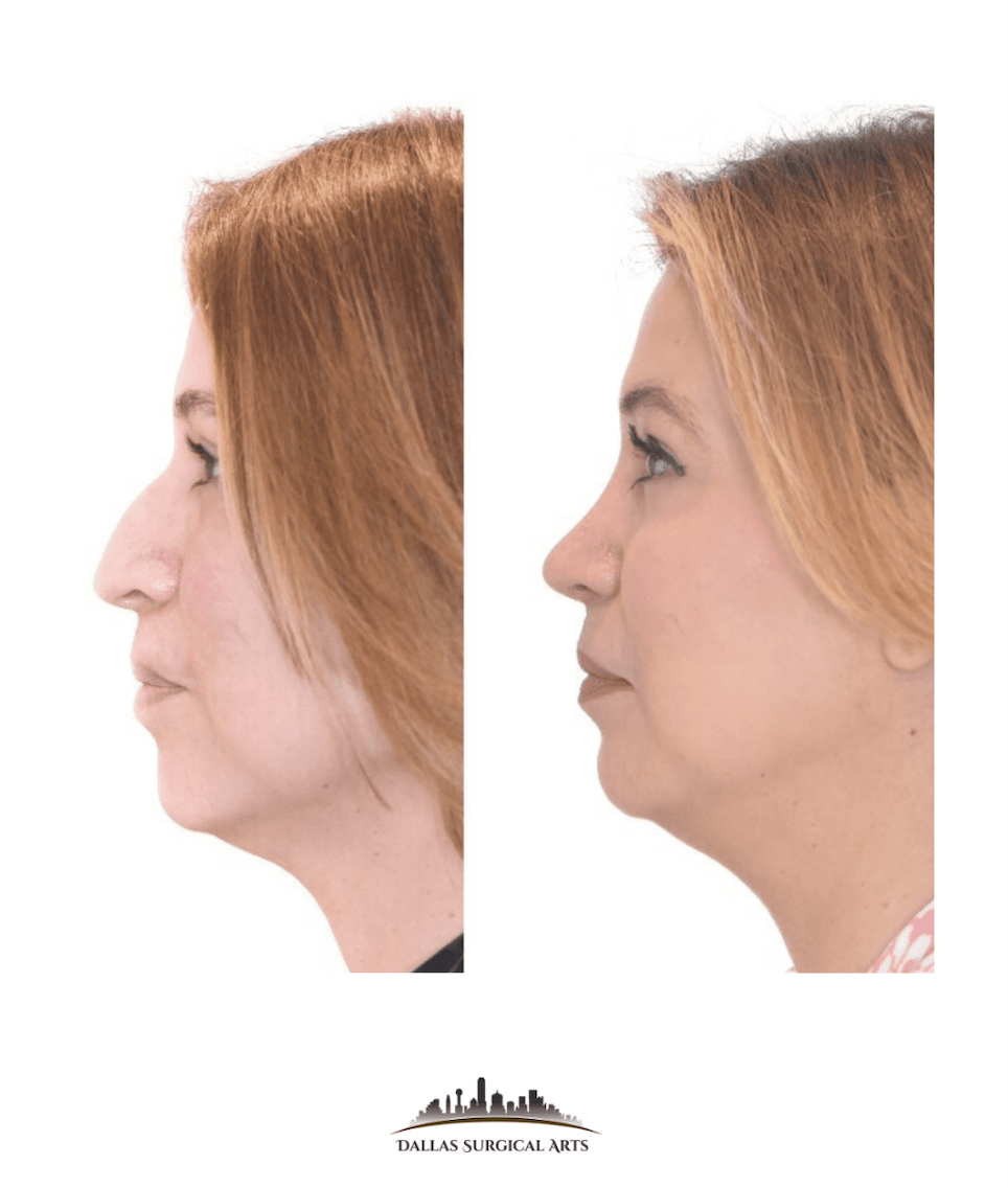 Dallas Rhinoplasty Cost Dallas Rhinoplasty Surgeon Dr Randy Sanovich Dallas Surgical Arts