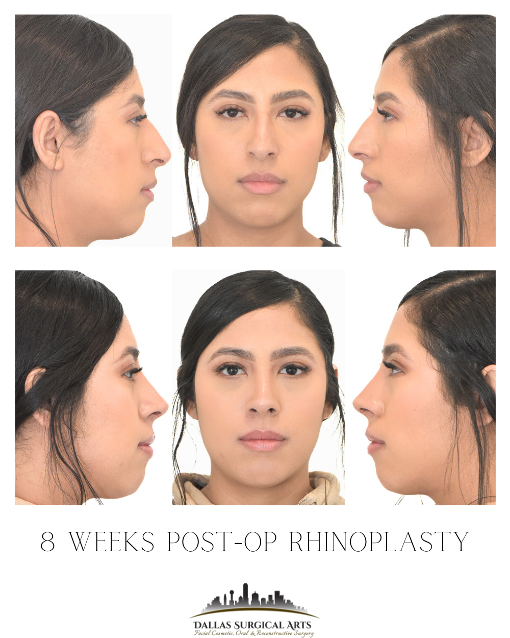 Dallas Rhinoplasty Cost Dallas Rhinoplasty Surgeon Dr Randy Sanovich Dallas Surgical Arts