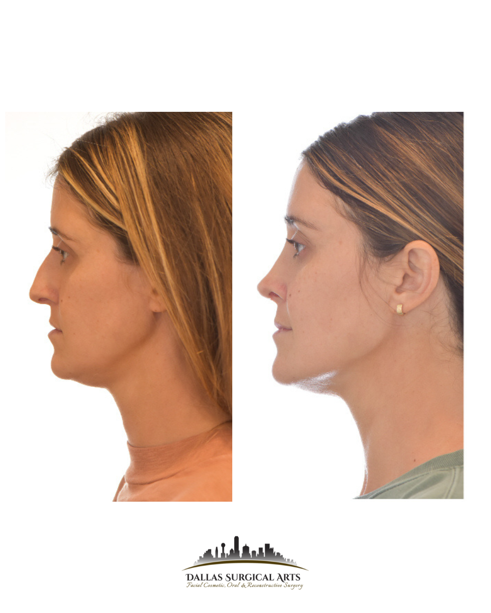 Dallas Rhinoplasty Cost Dallas Rhinoplasty Surgeon Dr Randy Sanovich Dallas Surgical Arts