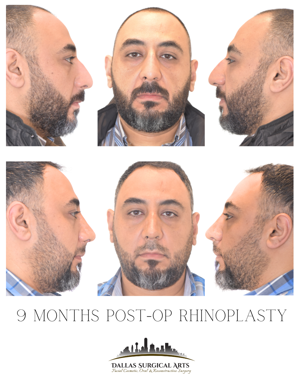 Dallas Rhinoplasty Cost Dallas Rhinoplasty Surgeon Dr Randy Sanovich Dallas Surgical Arts