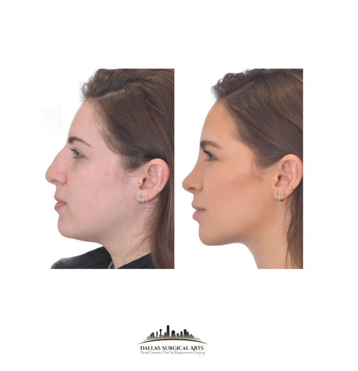 Dallas Rhinoplasty Cost Dallas Rhinoplasty Surgeon Dr Randy Sanovich Dallas Surgical Arts
