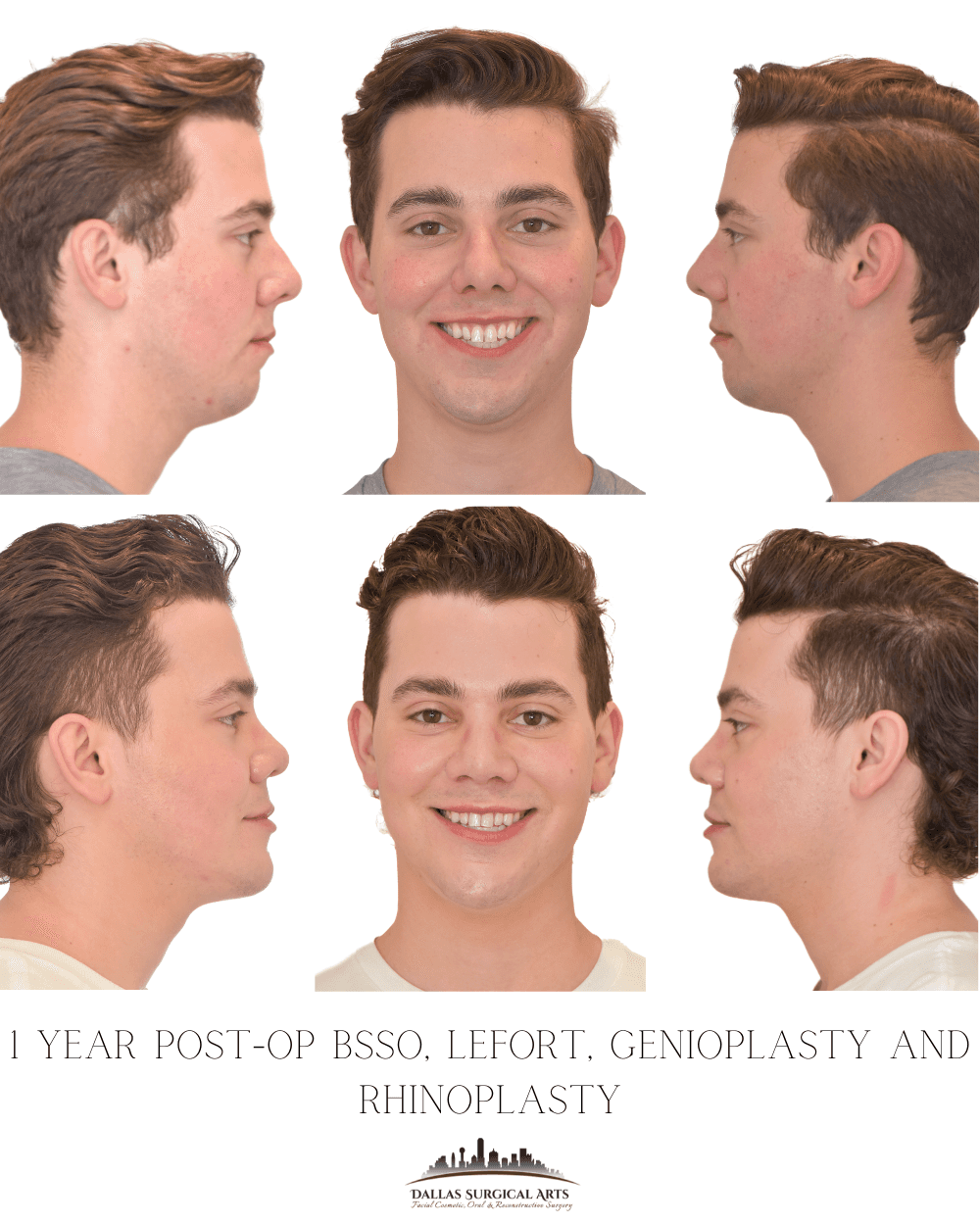 Dallas Rhinoplasty Cost Dallas Rhinoplasty Surgeon Dr Randy Sanovich Dallas Surgical Arts