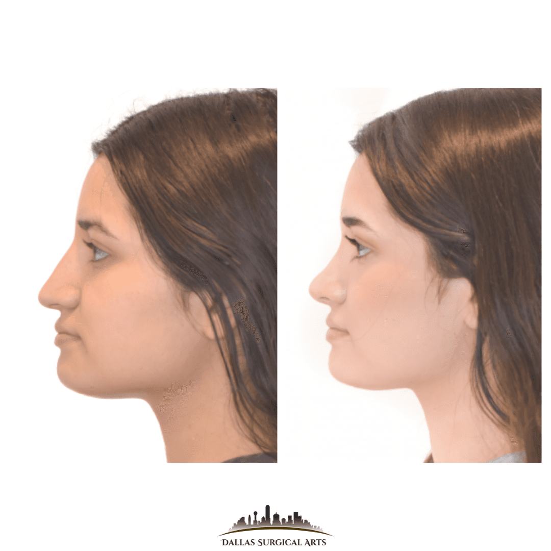 Dallas Rhinoplasty Cost Dallas Rhinoplasty Surgeon Dr Randy Sanovich Dallas Surgical Arts